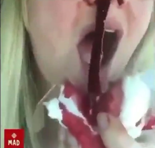 vax nose clot sensitive