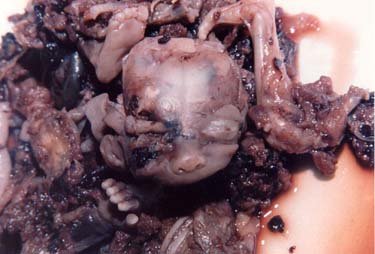 aborted fetus 1