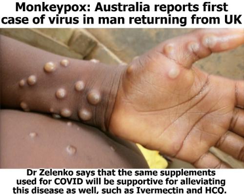 Monkeypox Sky News Australia 628px