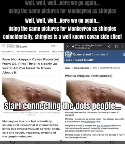 Monkey Pox or Shingles