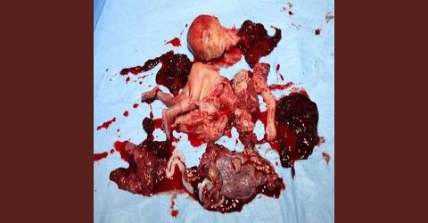 baby abortion