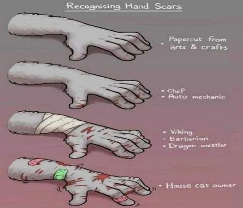 USA hand scars