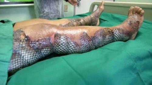 Fish Skin, Medical Procedures -- grafted to burns-diabetic wounds into new living tissue