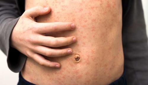measles ILLEGAL ALIENS